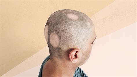 alopecia 中文